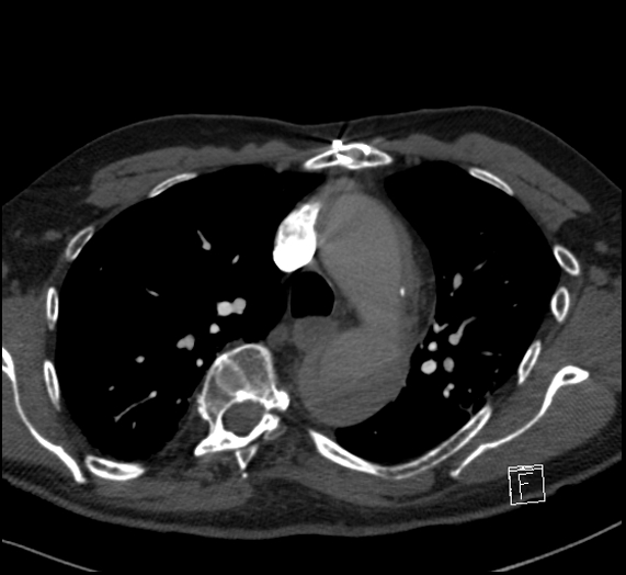 File:Aortic dissection (CTPA) (Radiopaedia 75506-86751 Axial C+ CTPA 47).jpg