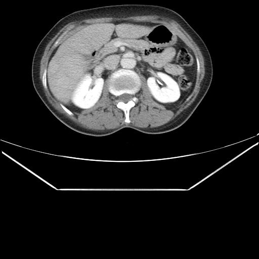 Aortic dissection (Radiopaedia 25350-25604 C 59).jpg