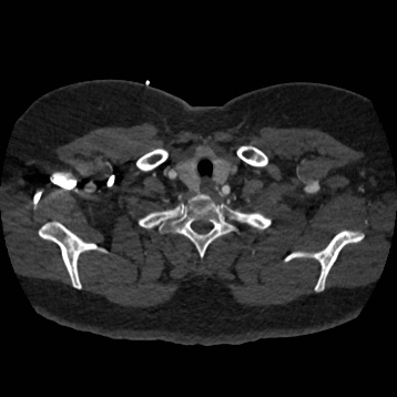 Aortic dissection (Radiopaedia 57969-64959 A 27).jpg