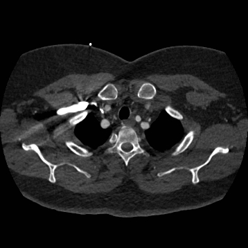 Aortic dissection (Radiopaedia 57969-64959 A 49).jpg