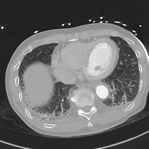 Aortic dissection - DeBakey type II (Radiopaedia 64302-73082 Axial lung window 47).png