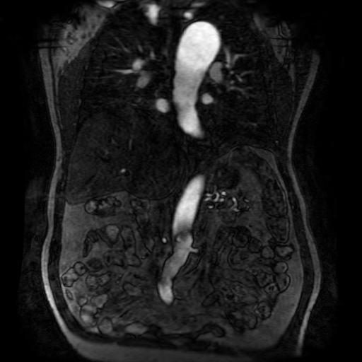 Aortic dissection - Stanford A - DeBakey I (Radiopaedia 23469-23551 D 122).jpg