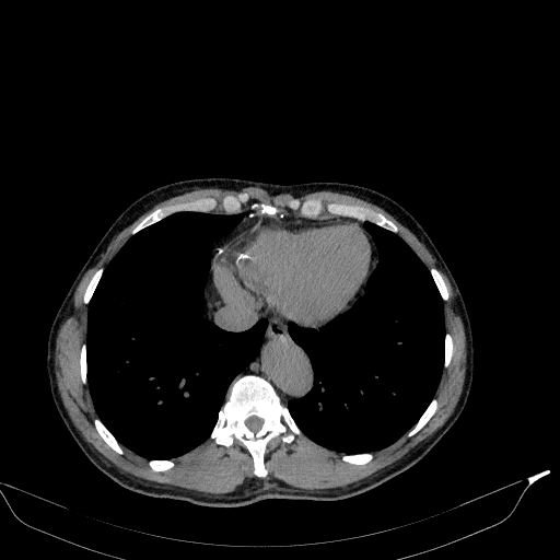 Aortic dissection - Stanford type A (Radiopaedia 83418-98500 Axial non-contrast 34).jpg
