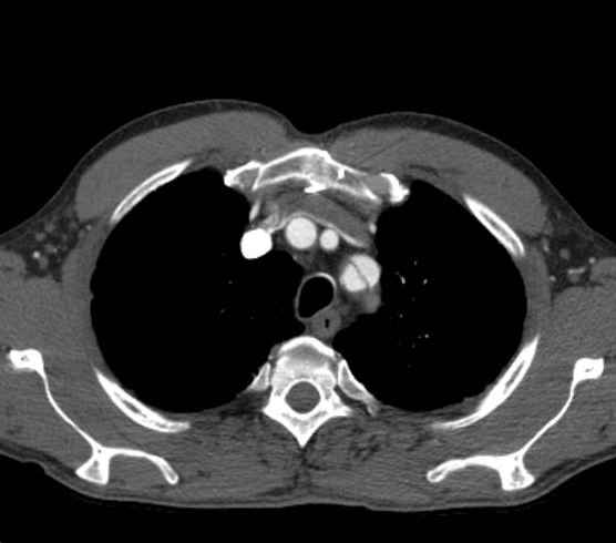Aortic dissection - Stanford type B (Radiopaedia 73648-84437 A 11).jpg