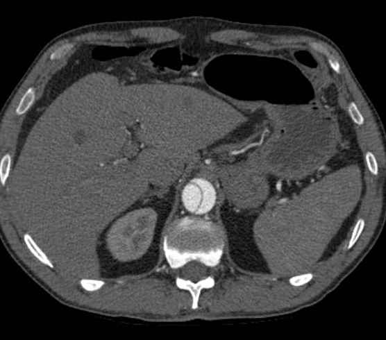 Aortic dissection - Stanford type B (Radiopaedia 73648-84437 A 115).jpg