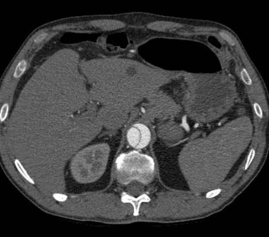 Aortic dissection - Stanford type B (Radiopaedia 73648-84437 A 117).jpg