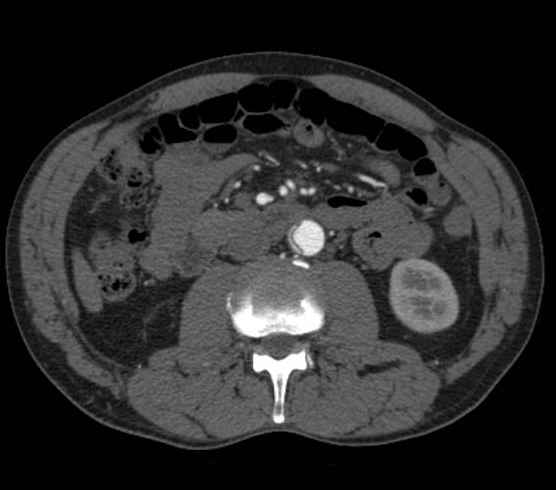 File:Aortic dissection - Stanford type B (Radiopaedia 73648-84437 A 162).jpg