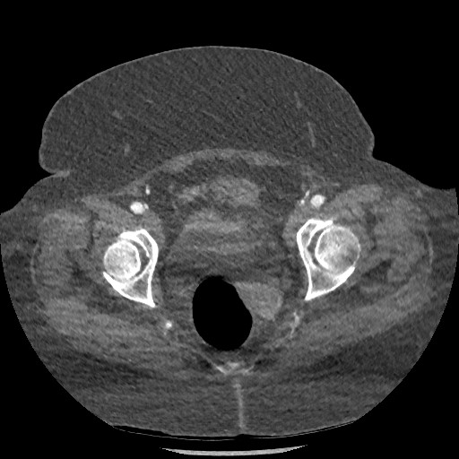 Aortic dissection - Stanford type B (Radiopaedia 88281-104910 A 155).jpg