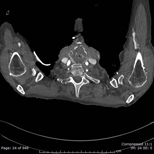 File:Aortic dissection with extension into aortic arch branches (Radiopaedia 64402-73204 B 24).jpg