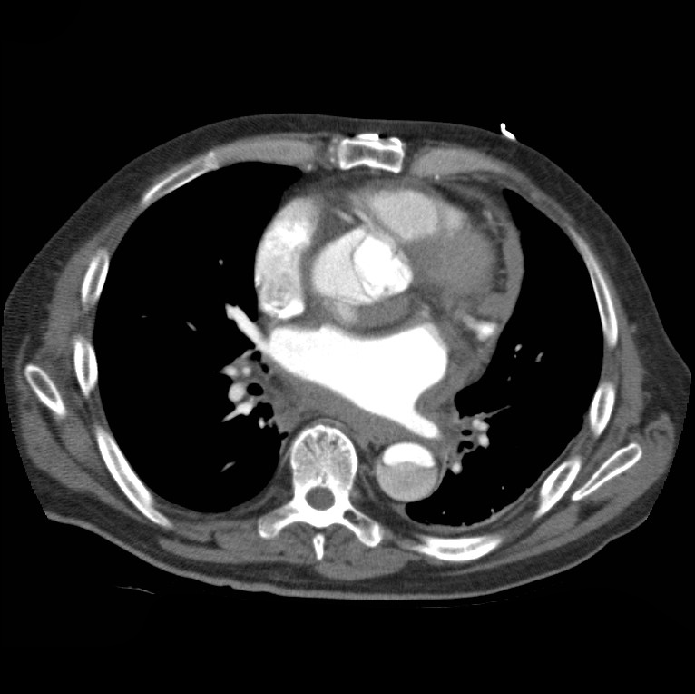 Aortic dissection with rupture into pericardium (Radiopaedia 12384-12647 A 32).jpg