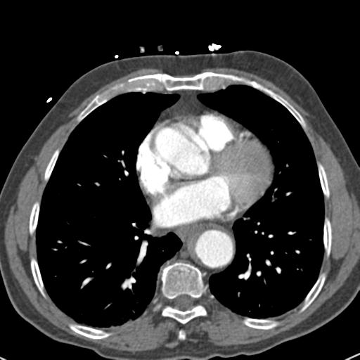Aortic intramural hematoma (Radiopaedia 31139-31838 B 56).jpg
