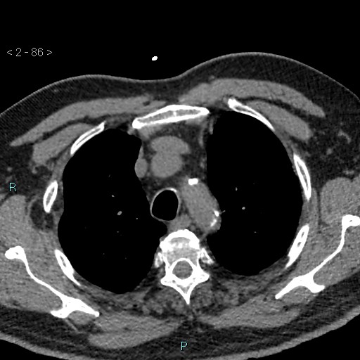 Aortic intramural hematoma (Radiopaedia 48463-53380 Axial non-contrast 38).jpg