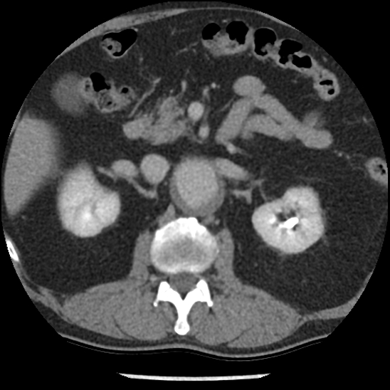 Aortic intramural hematoma (type B) (Radiopaedia 79323-92387 Axial C+ delayed 65).jpg
