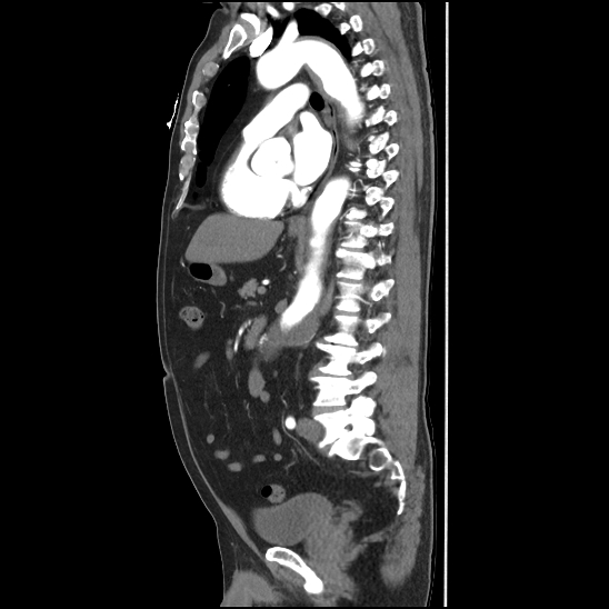 Aortic intramural hematoma (type B) (Radiopaedia 79323-92387 H 29).jpg