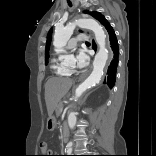 File:Aortic intramural hematoma from penetrating atherosclerotic ulcer (Radiopaedia 31137-31836 B 16).jpg