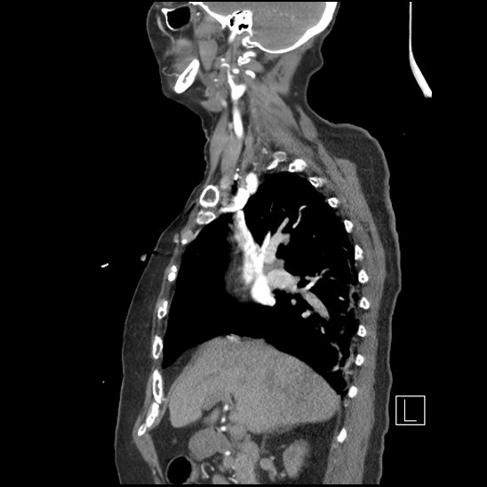Aortic intramural hematoma with dissection and intramural blood pool (Radiopaedia 77373-89491 D 31).jpg