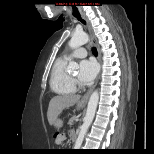 File:Aortic valve stenosis (Radiopaedia 14480-14423 B 3).jpg
