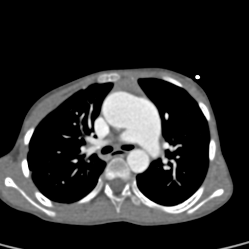 File:Aortopulmonary window, interrupted aortic arch and large PDA giving the descending aorta (Radiopaedia 35573-37074 B 33).jpg