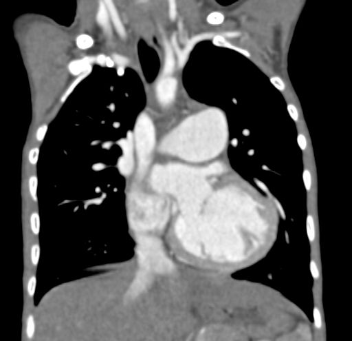 File:Aortopulmonary window, interrupted aortic arch and large PDA giving the descending aorta (Radiopaedia 35573-37074 D 31).jpg