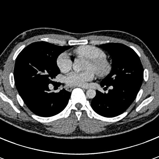 Apical lung mass mimic - neurogenic tumor (Radiopaedia 59918-67521 A 44).jpg