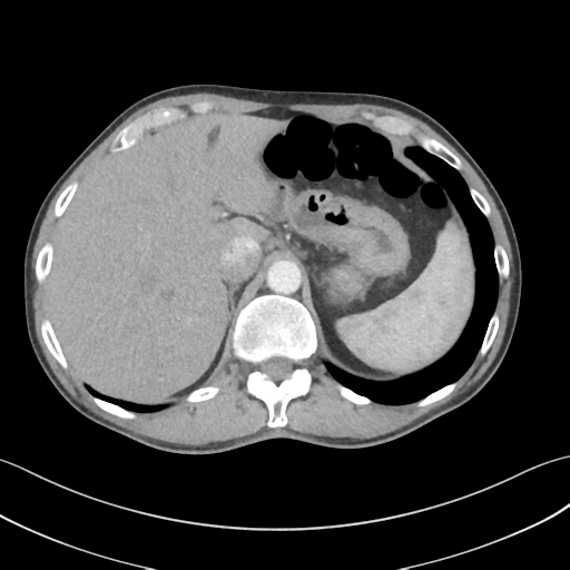 File:Apical pleural calcification (Radiopaedia 46141-50499 Axial C+ delayed 67).png