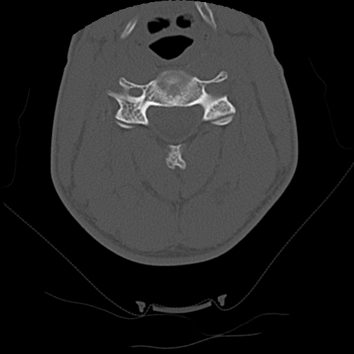 File:Apical pneumothorax on cervical spine CT (Radiopaedia 45343-49368 Axial bone window 40).jpg