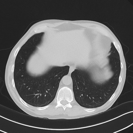 Apical pulmonary metastasis (Radiopaedia 46338-50754 Axial non-contrast 52).png