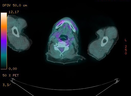 Appendiceal adenocarcinoma complicated by retroperitoneal abscess (Radiopaedia 58007-65041 Axial PET-CT 14).jpg