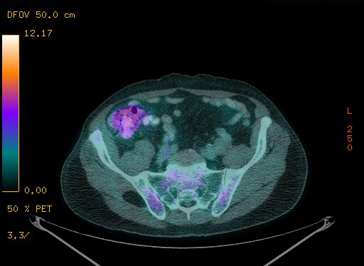 File:Appendiceal adenocarcinoma complicated by retroperitoneal abscess (Radiopaedia 58007-65041 Axial PET-CT 162).jpg