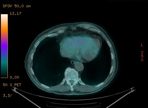 Appendiceal adenocarcinoma complicated by retroperitoneal abscess (Radiopaedia 58007-65041 Axial PET-CT 93).jpg