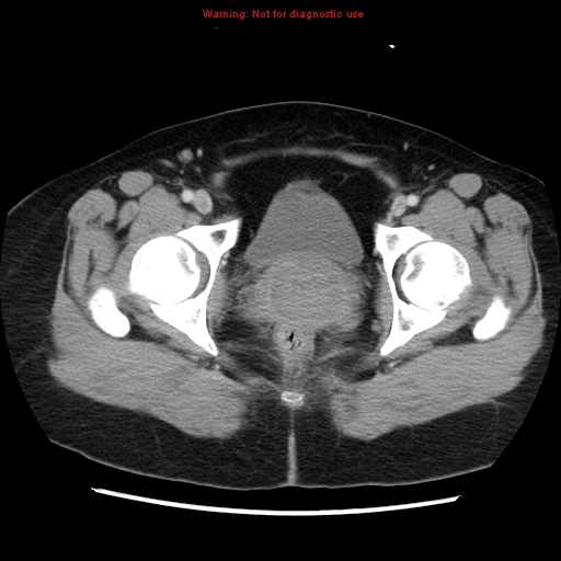 Appendiceal mucinous cystadenoma (Radiopaedia 8263-9111 Axial liver window 77).jpg