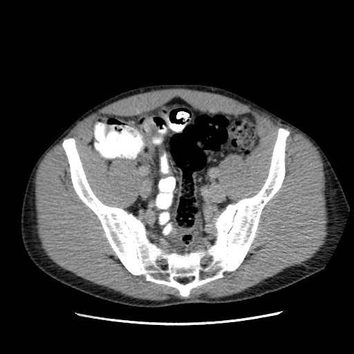 File:Appendicitis complicated by post-operative collection (Radiopaedia 35595-37113 A 60).jpg