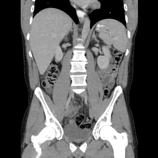 Appendicitis complicated by post-operative collection (Radiopaedia 35595-37114 B 31).jpg