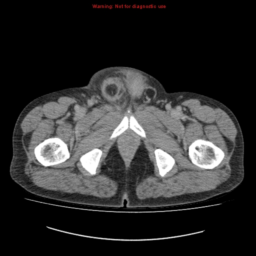 File:Appendicitis mass in inguinal hernia (Radiopaedia 26858-27029 A 36).jpg
