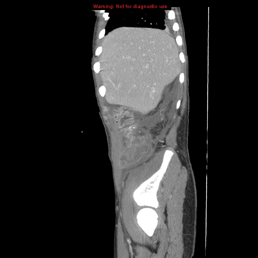 File:Appendicitis with phlegmon (Radiopaedia 9358-10046 F 5).jpg