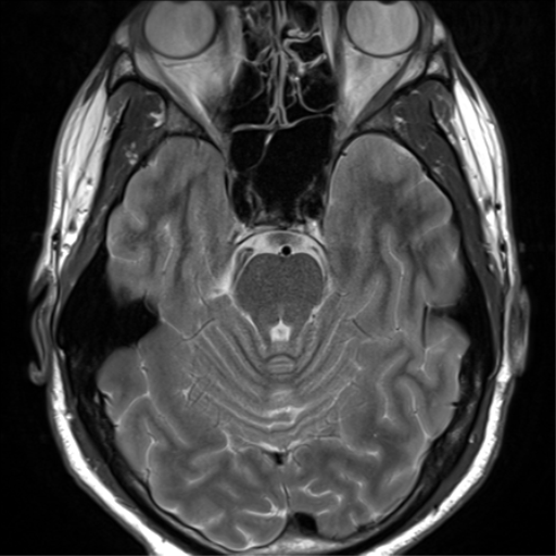 File:Arachnoid cyst - cerebellopontine angle (Radiopaedia 59689-67083 Axial T2 18).png