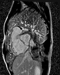 File:Arrhythmogenic right ventricular cardiomyopathy (Radiopaedia 57972-64966 D 3).jpg