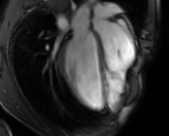 Arrhythmogenic right ventricular cardiomyopathy (Radiopaedia 69564-79464 4ch cine 79).jpg