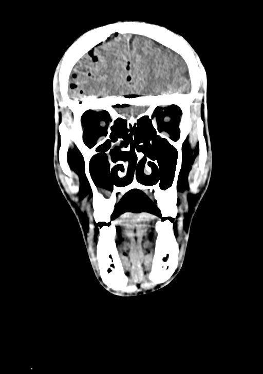 Arrow injury to the brain (Radiopaedia 72101-82607 Coronal non-contrast 23).jpg