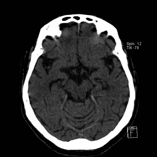 File:Artery of Percheron infarction (Radiopaedia 26307-26439 Axial non-contrast 1).jpg