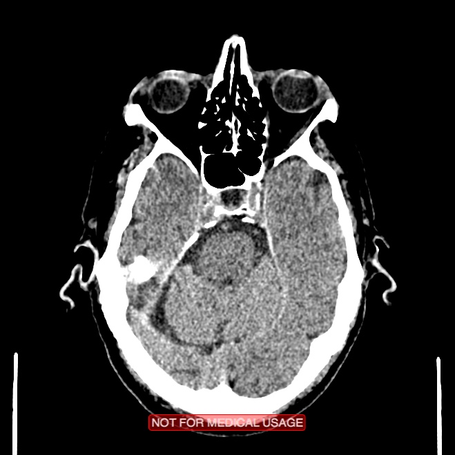 Artery of Percheron infarction (Radiopaedia 28679-28967 Axial non-contrast 38).jpg