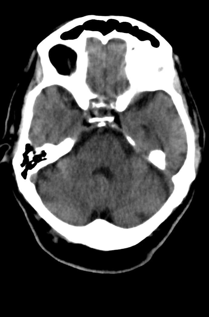 Artery of Percheron infarction (Radiopaedia 80613-94202 Axial non-contrast 63).jpg
