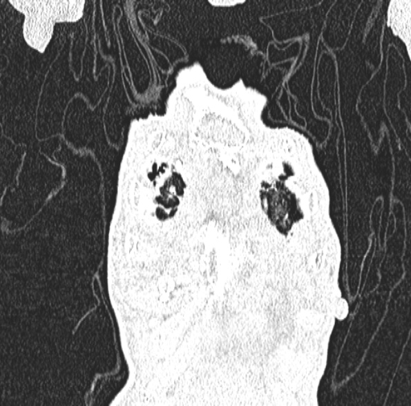 Aspergilloma- with Monod sign (Radiopaedia 44737-48532 Coronal lung window 127).jpg