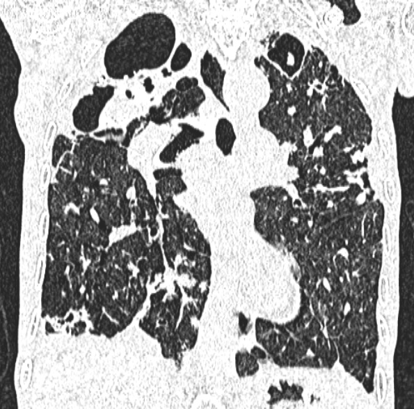 Aspergilloma- with Monod sign (Radiopaedia 44737-48532 Coronal lung window 254).jpg