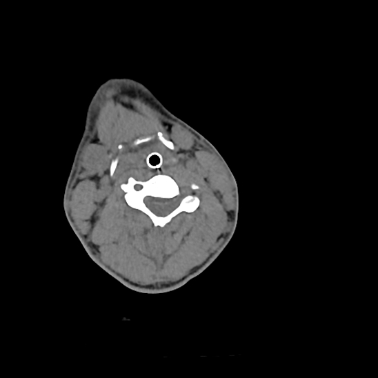 File:Atlanto-occipital dissociation (Traynelis type 1), C2 teardrop fracture, C6-7 facet joint dislocation (Radiopaedia 87655-104061 Axial non-contrast 44).jpg