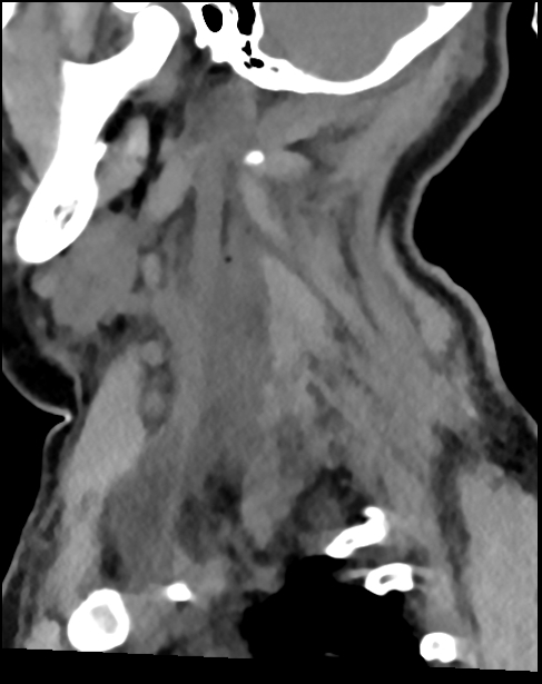 Atlanto-occipital dissociation - Traynelis type 1 (Radiopaedia 87570-103948 D 64).jpg