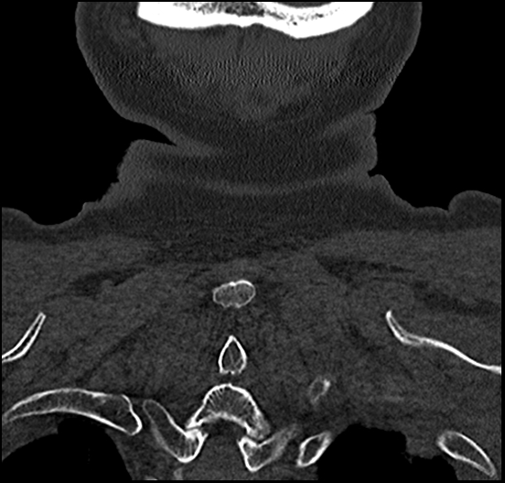 Atlas (type 3b subtype 1) and axis (Anderson and D'Alonzo type 3, Roy-Camille type 2) fractures (Radiopaedia 88043-104607 Coronal bone window 59).jpg