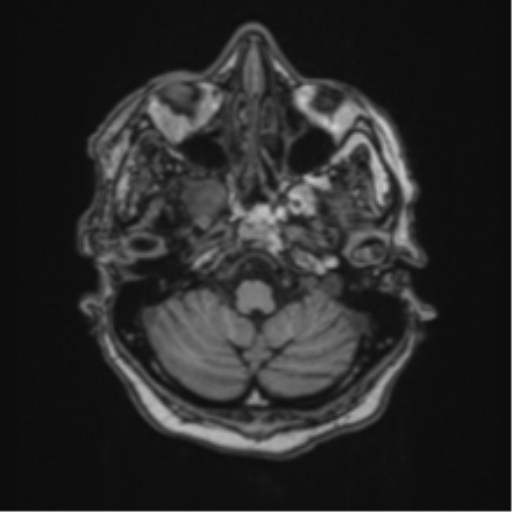 Atypical meningioma (WHO Grade II) (Radiopaedia 54742-60981 Axial T1 12).png
