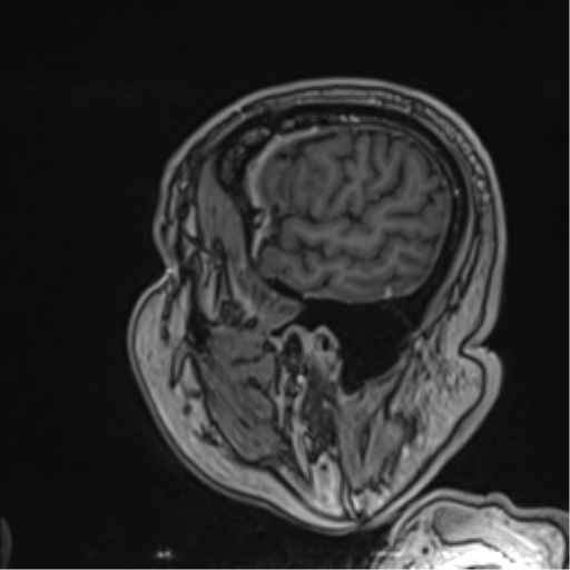Atypical meningioma (WHO grade II) with brain invasion (Radiopaedia 57767-64729 Sagittal T1 C+ 56).png