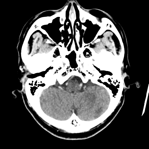 Atypical meningioma (WHO grade II) with osseous invasion (Radiopaedia 53654-59715 Axial C+ delayed 12).png